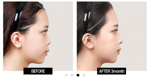 View韩国鼻子修复手术3DCT私人定制健康与协调并存的美鼻！