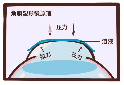 目立康新品Menicon Z Night亮点多多,儿童青少年近视防控更进一步