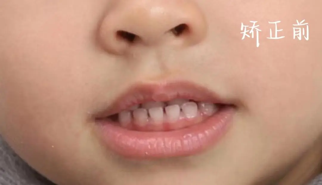 儿童早矫许跃教授：孩子地包天，其实是上颌发育落后了！需引导生长，解反颌